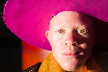 Albinism and Climate Change: A Lethal Intersection Demanding Global Health Equity